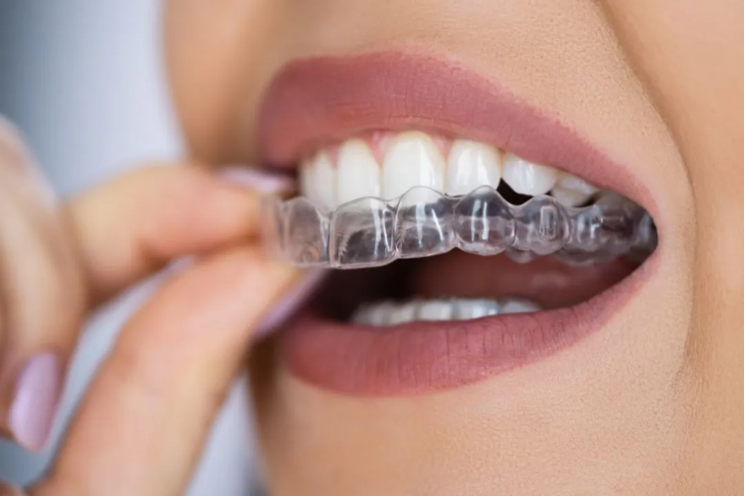 Teeth straightening Cambourne — SureSmile clear aligners at Monkfield Dental