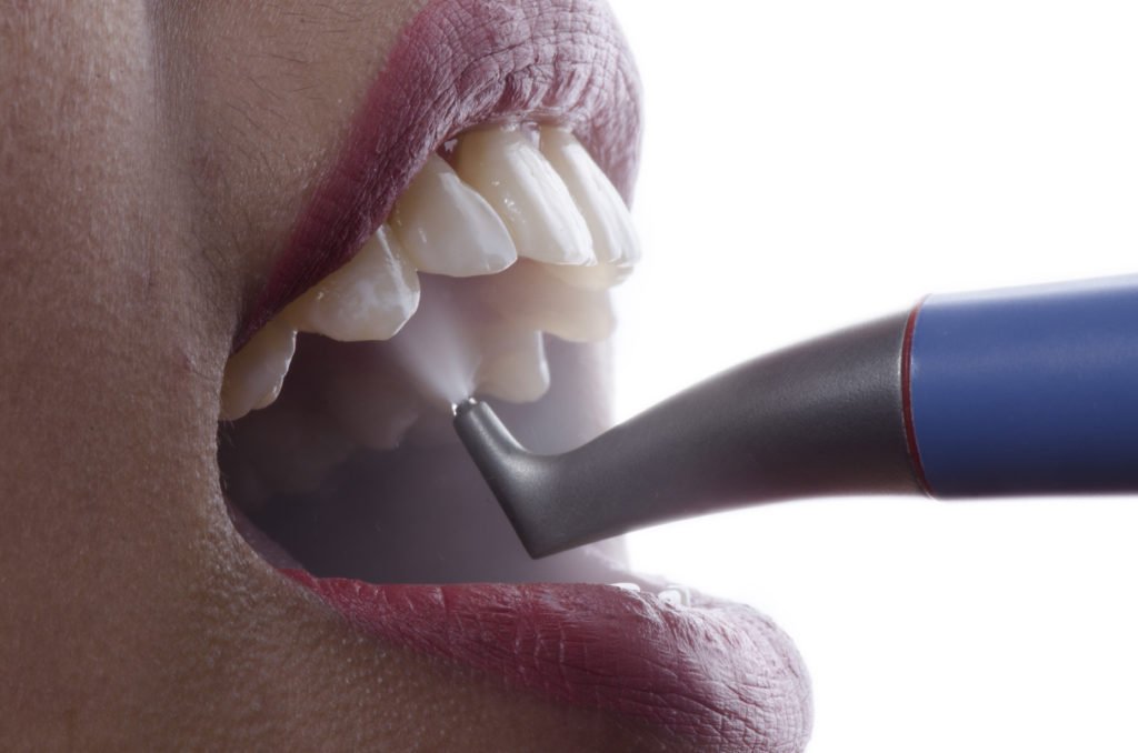 AirPolish stain removal Cambourne — professional tooth cleaning at Monkfield Dental