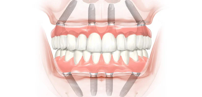 All-on-4 dental implants Cambourne — full arch prosthesis at Monkfield Dental